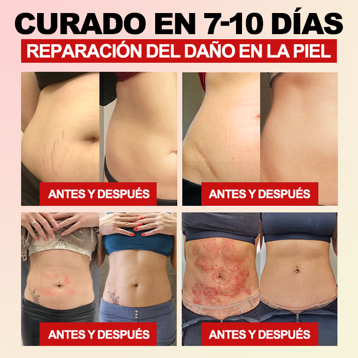 ¡Sólo quedan las últimas 5 piezas! 🔥¡Ahora ofrecemos un 30% de descuento adicional! Recomendado por expertos en bariatría, 4-5 piezas son suficientes para restaurar completamente su figura sin el alto costo. ¡No se lo pierda y espere un año!