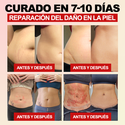 ¡Sólo quedan las últimas 5 piezas! 🔥¡Ahora ofrecemos un 30% de descuento adicional! Recomendado por expertos en bariatría, 4-5 piezas son suficientes para restaurar completamente su figura sin el alto costo. ¡No se lo pierda y espere un año!